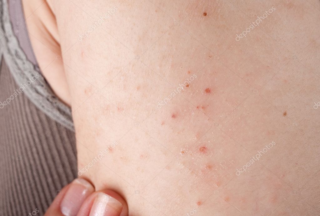 Dermatite Allergica Eruzione Cutanea Foto Stock Foto Immagini Librakv Depositphotos