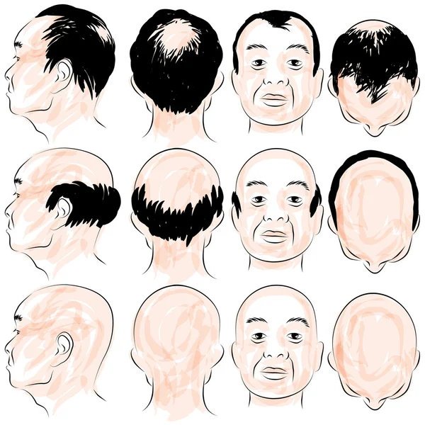 亚洲男性秃头模式 — 图库矢量图片