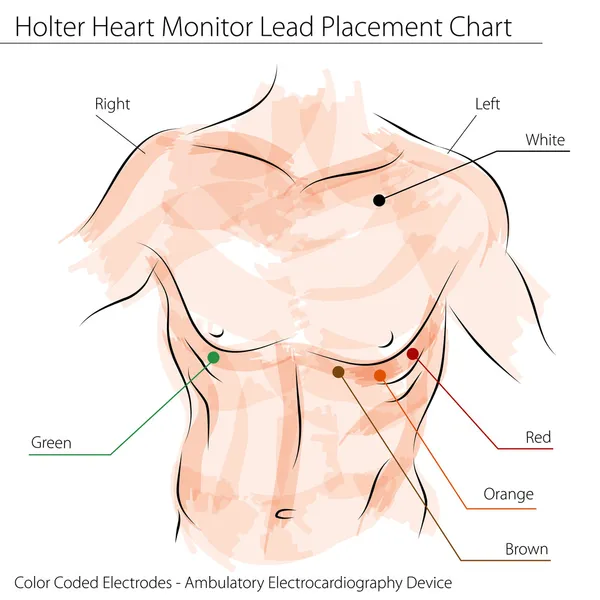 Monitorowania EKG metodą Holtera serca prowadzić wykres umieszczenie — Wektor stockowy
