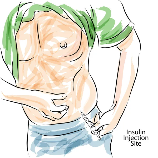 Diabetes Insulin Injection Site — Stock Vector