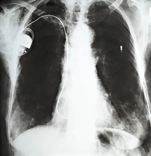 ペース メーカー心臓病の薬 — ストック写真