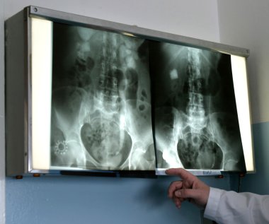 Kidneys x-ray 1 clipart