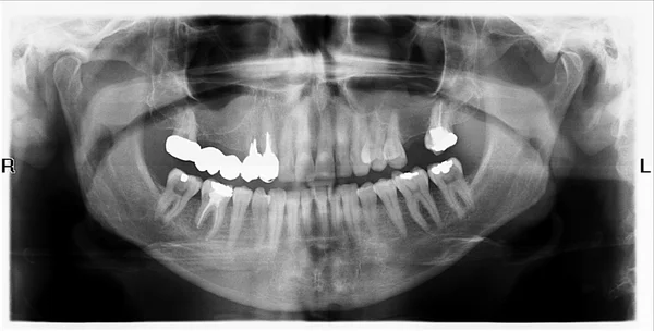 Tanden op x-ray afbeelding — Stockfoto