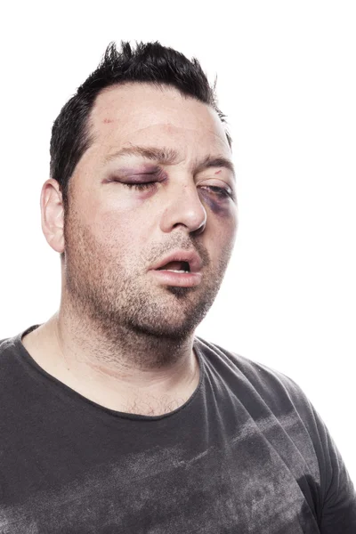 Siyah göz yaralanma kaza şiddet izole — Stok fotoğraf