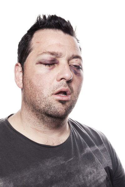 Black eye injury accident violence isolated