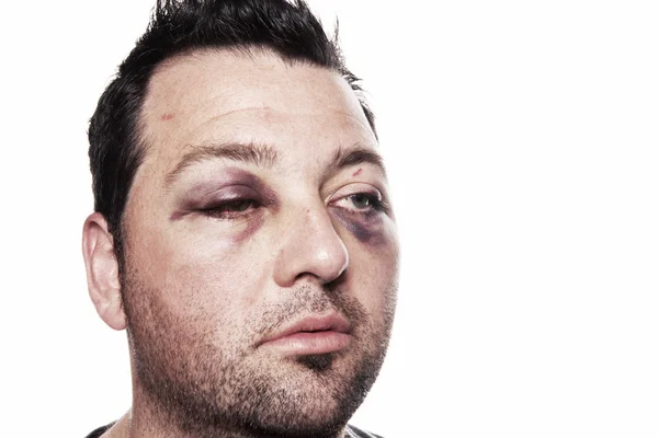 stock image Black eye injury accident violence isolated