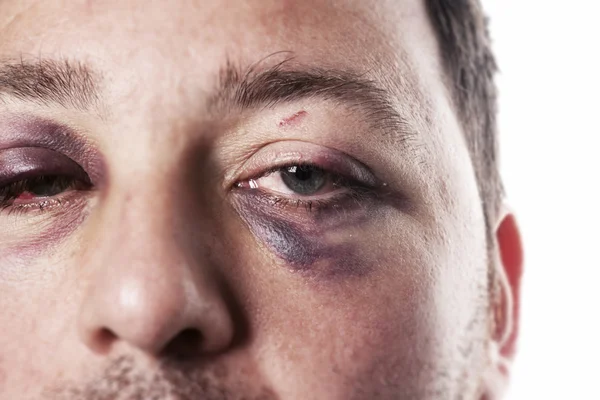 Black eye injury accident violence isolated — Stock Photo, Image