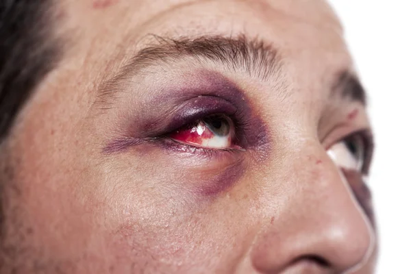 stock image Black eye injury accident violence isolated