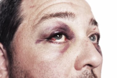 Black eye injury accident violence isolated clipart