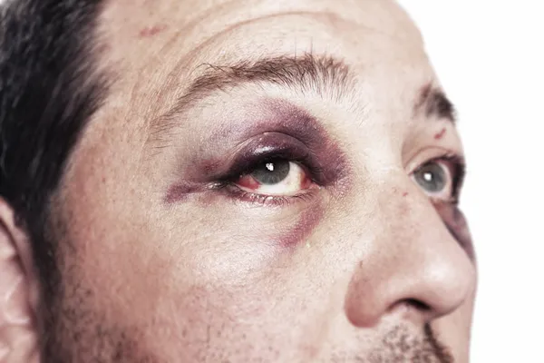 Изолированное насилие при травме глаза — стоковое фото