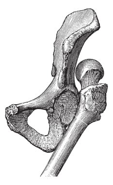 Dislocation of the hip, vintage engraving. clipart