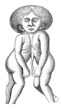 Fig. 628. One head and two bodies conjointed twin, vintage engra clipart