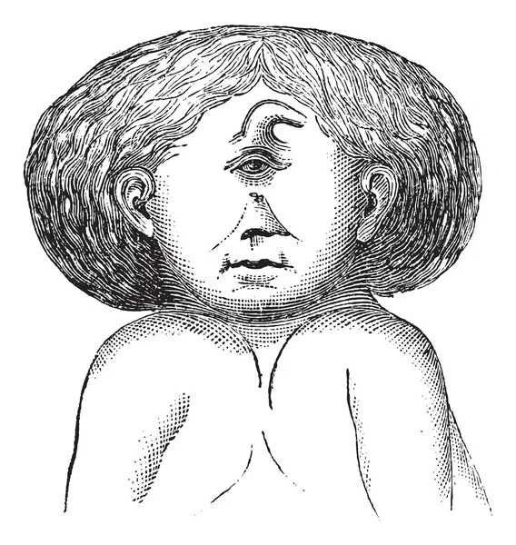 Fig. 629. Una testa e due corpi uniti gemelli, vintage engrav — Vettoriale Stock