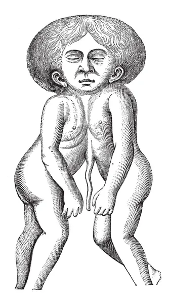 Fig. 628. Una testa e due corpi uniti gemelli, vintage engra — Vettoriale Stock