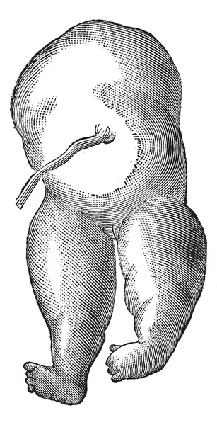 Fig. 36. Acefalia un tipo di disturbo cefalico, incisione vintage — Vettoriale Stock