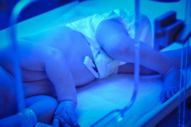 Newborn jaundice clipart