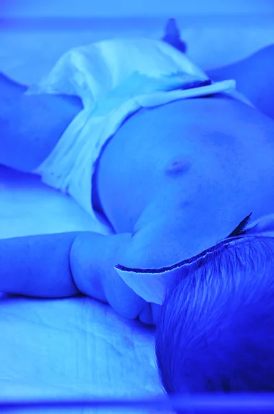 Icterícia neonatal — Fotografia de Stock