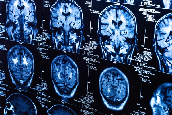 Un grupo de TAC escanea el cerebro humano — Foto de Stock