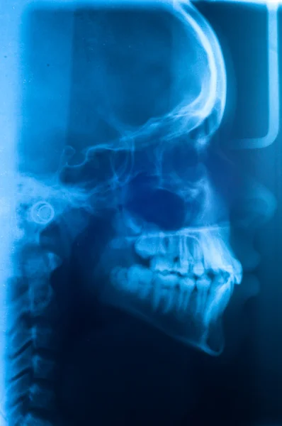 人間の頭蓋骨のスキャン — ストック写真