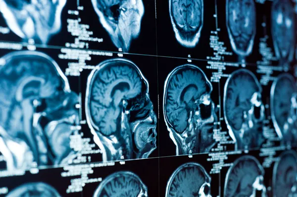 Detailní záběr na ct vyšetření mozku a lebky, na něm — Stock fotografie