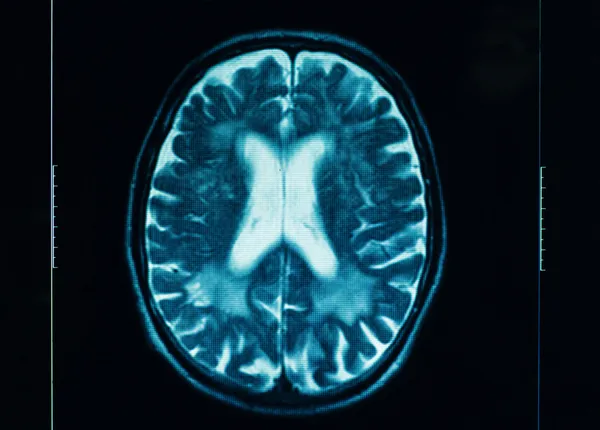 Tomografia computadorizada do cérebro humano — Fotografia de Stock