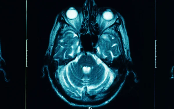 Skarpa datortomografi av hjärnan — Stockfoto