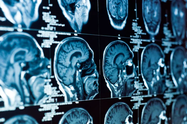 Närbild av en datortomografi med hjärnan och skallen på det Stockbild