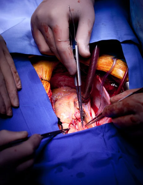 Крупный план операции на сердце — стоковое фото