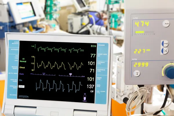 Cardiogram with ECMO and intra-aortic balloon counterpulsation i — Stock Photo, Image