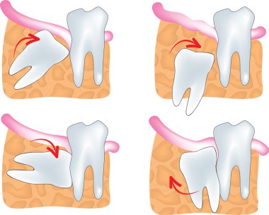 Impacted wisdom tooth clipart