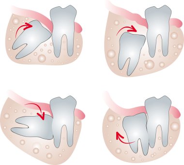 Impacted wisdom tooth clipart