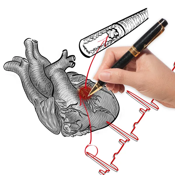 Orvos rajz a szívroham és a szív dobog cardiogram — Stock Fotó