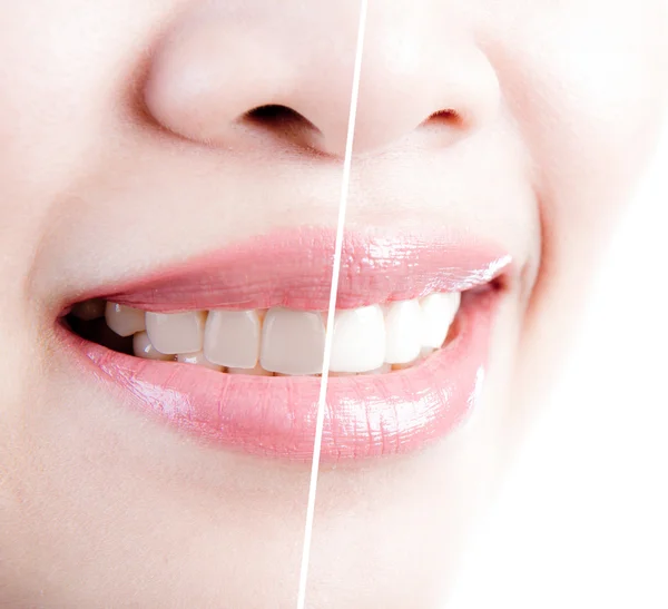 Жіночі зуби до і після відбілювання. Над білим тлом — стокове фото