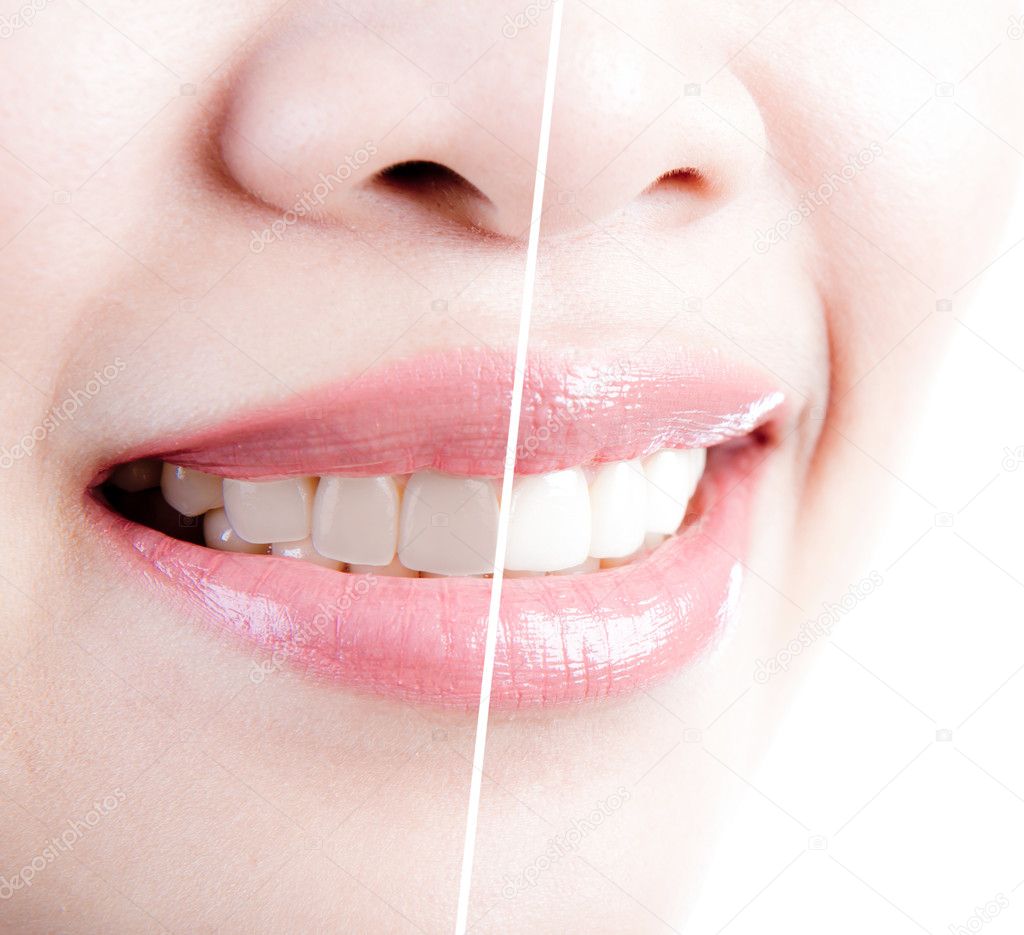 Woman teeth before and after whitening. Over white background