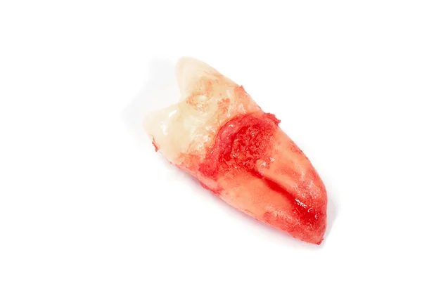 Extraktion av tand med dental verktyg och utrustning — Stockfoto