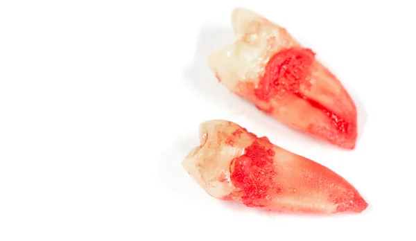 Extractie van tand met tandheelkundige gereedschappen en werktuigen — Stockfoto