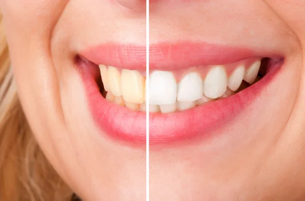 Отбеливание зубов — стоковое фото