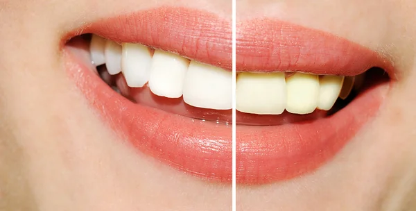 Женские зубы до и после отбеливания — стоковое фото
