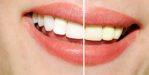 Woman teeth before and after whitening