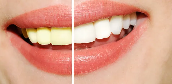 Frauenzähne vor und nach dem Bleaching — Stockfoto