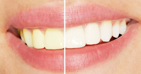Kadın diş beyazlatma sonra ve daha önce - Stok İmaj