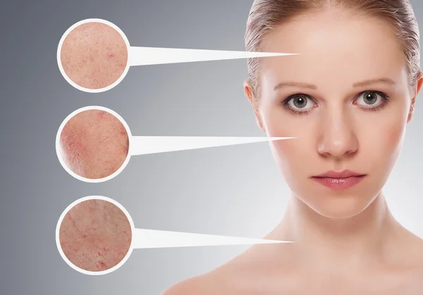 Begreppet hudvård. hud skönhet ung kvinna före och efter th — Stockfoto