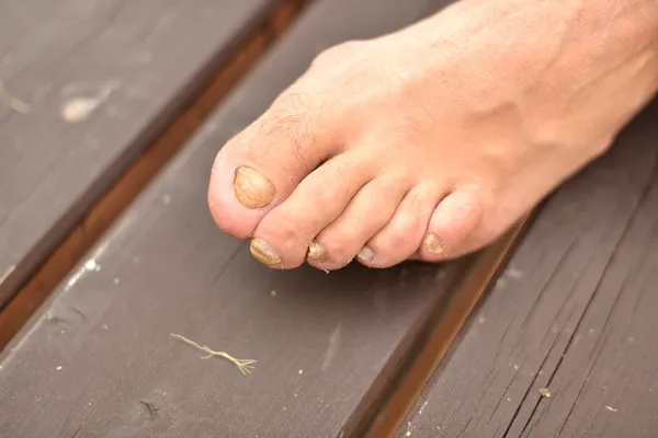 Агрессивный грибок ногтей на ногах (крупный план) ). — стоковое фото