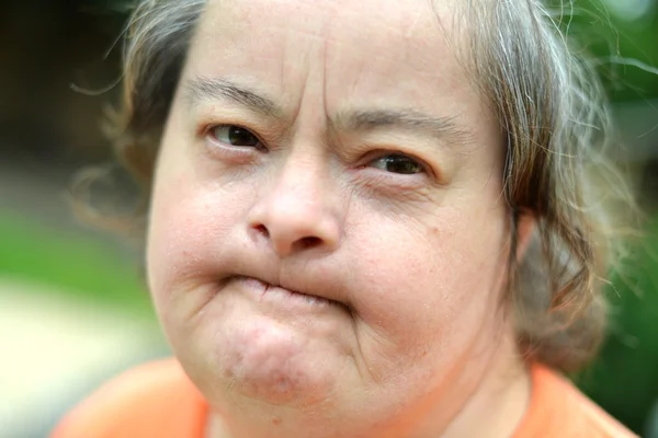 Woman with down syndrome — Stock Photo, Image