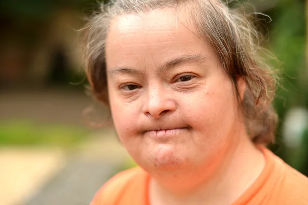 다운 증후군을 가진 여자 — 스톡 사진