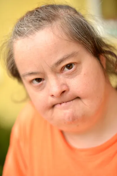 Mujer con síndrome de Down — Foto de Stock
