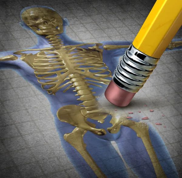 Ostéoporose humaine — Photo