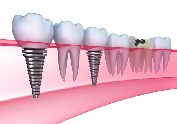 Tandheelkundige implantaten in het tandvlees - geïsoleerd op wit — Stockfoto