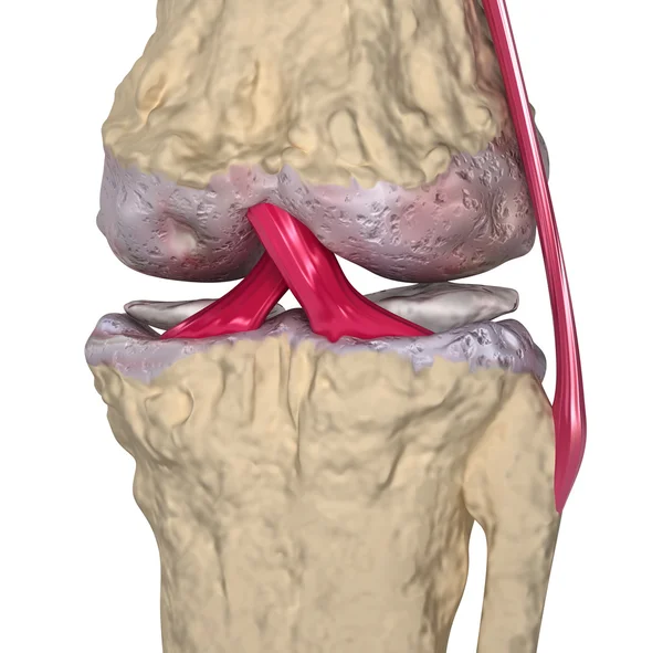 Остеоартроз: колінний суглоб із зв'язками та хрящами — стокове фото