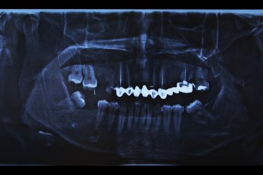 X-ray scan of humans teeth clipart